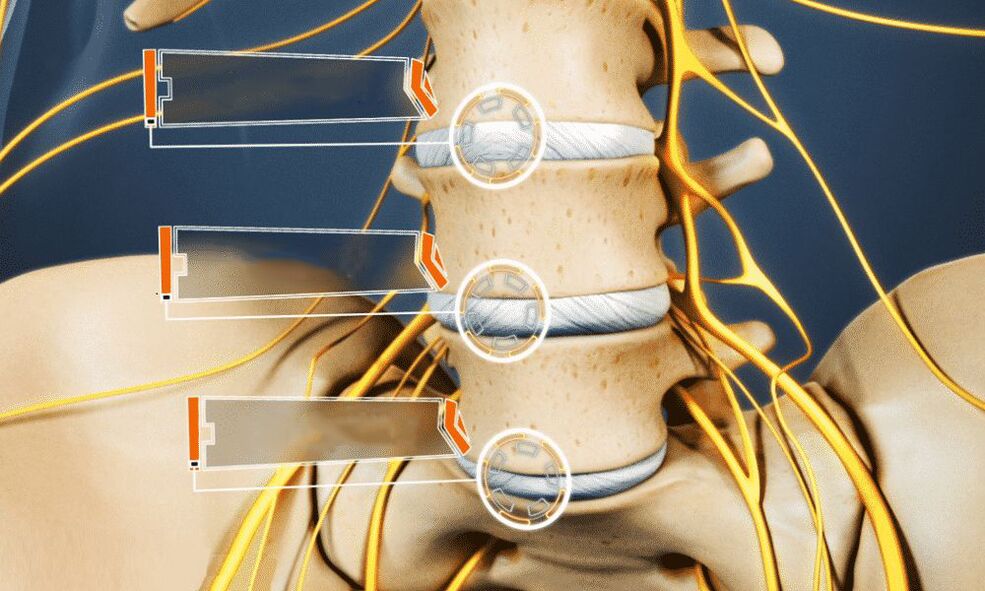 A hernia intervertebral leva á impotencia