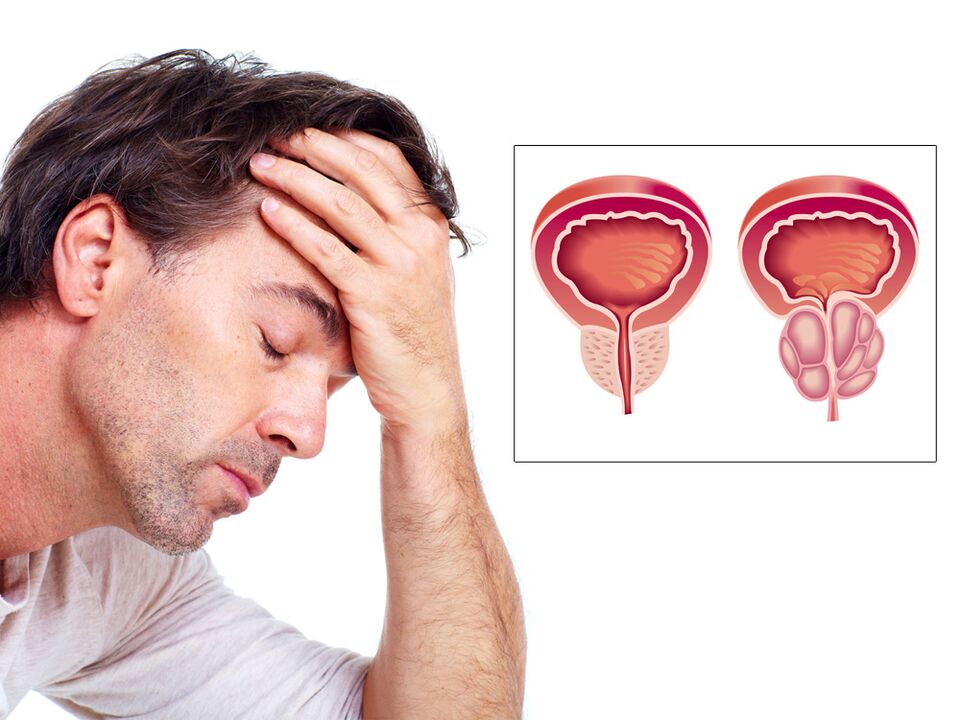 Adenoma de próstata con impotencia